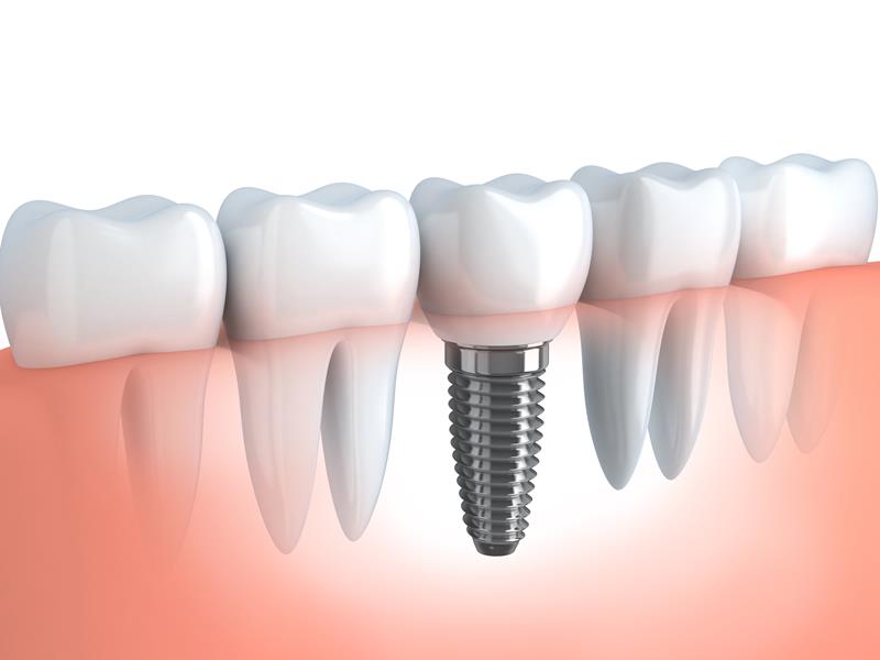 Dental Implants Fayetteville, NC 